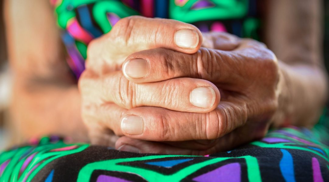 Woman with her arthritic hands in her lap.